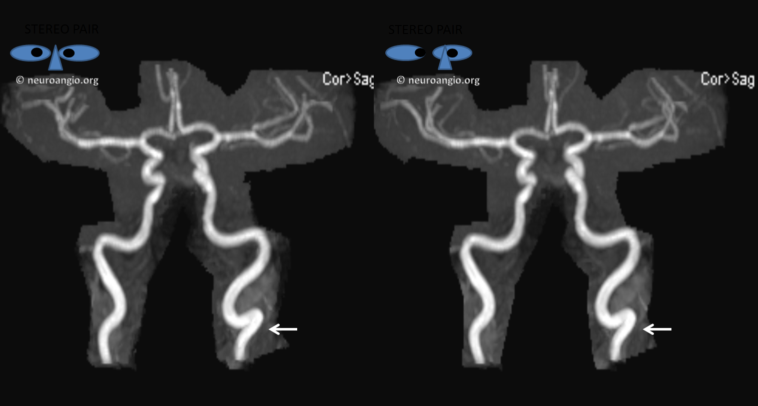 pulsatile-tinnitus-carotid-artery-loop-neuroangio